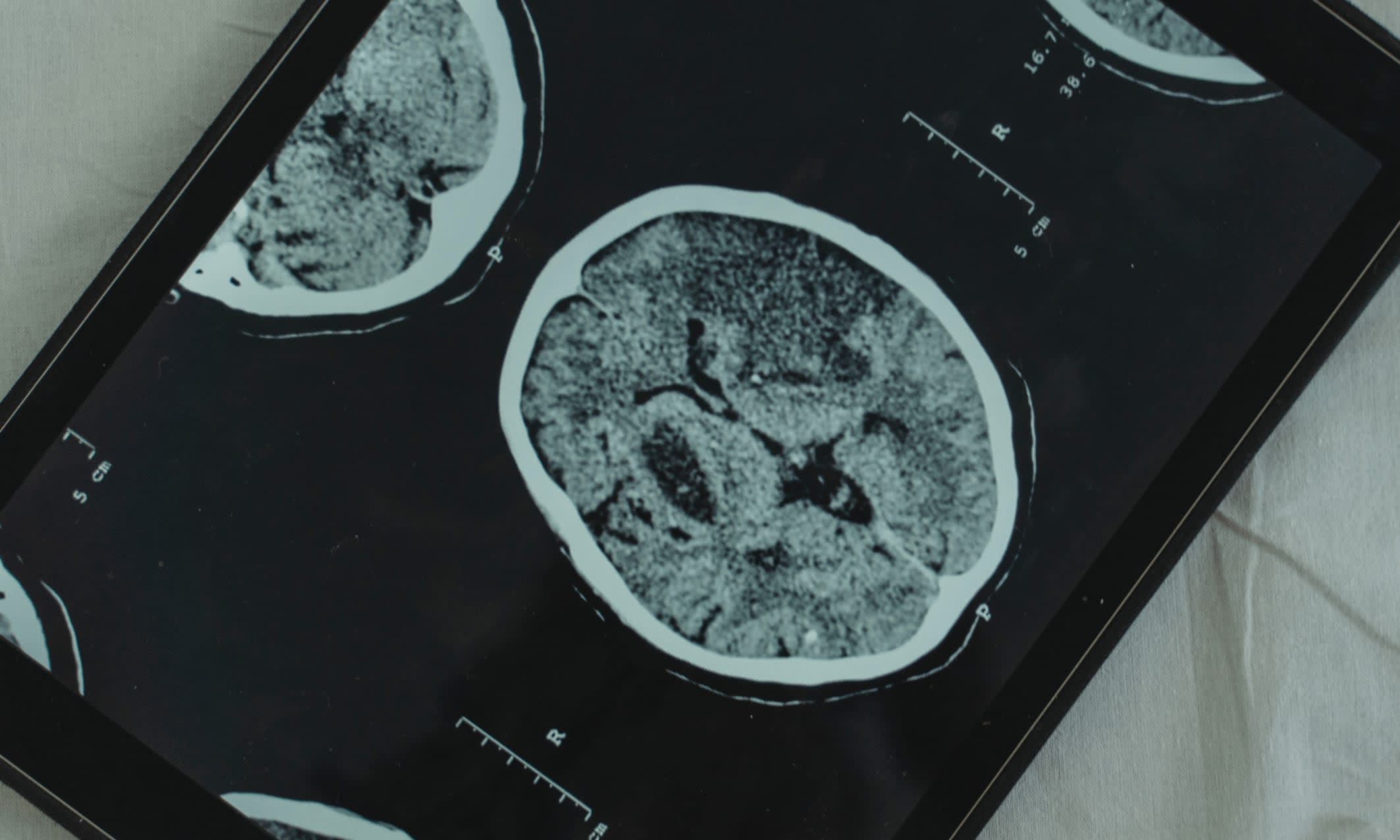 Brain MRI scan